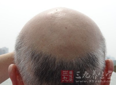 脱发的人，不要去碰何首乌
